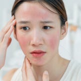 Pflege für zu Rosazea neigende Haut