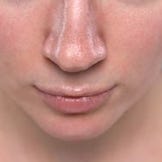 Pflege für zu Mitessern neigende Haut