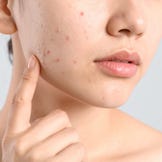 Pflegeprodukte für akne-anfällige Haut