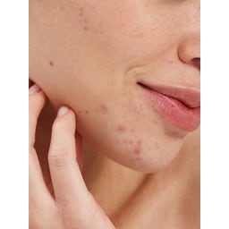 Pai Skincare Salicylic Acid Clarifying Booster - 10 мл