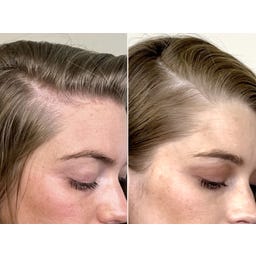 Living Proof Scalp Care Density Serum - 50 ml